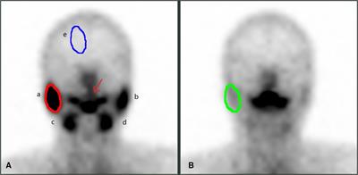 Optimal administration time of vitamin C after 131I therapy in differentiated thyroid cancer based on propensity score matching